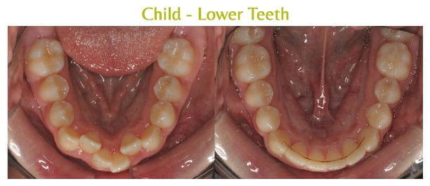 Before and after Arpino Orthodontics in Libertyville, IL