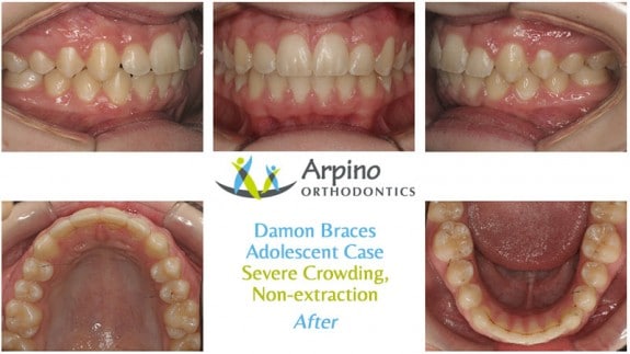 Before and after Arpino Orthodontics in Libertyville, IL