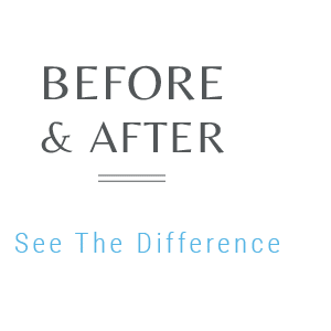Before and After Arpino Orthodontics LIbertyville IL